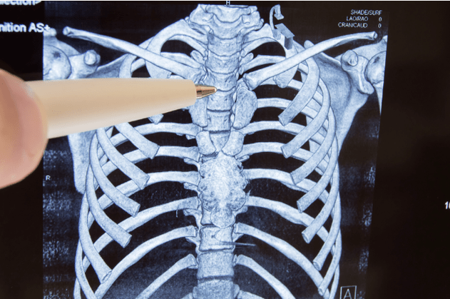 osteochondroză
