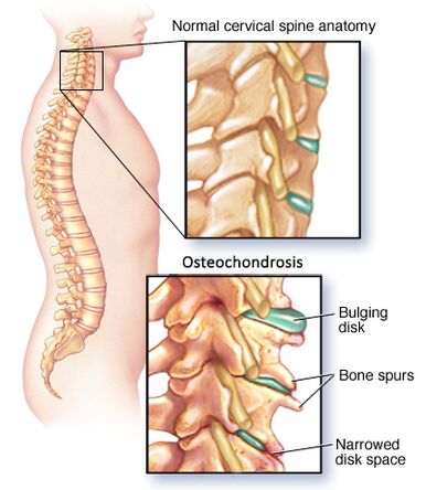 Osteochondroza cervicală