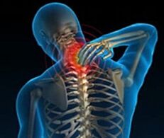 osteocondroza coloanei cervicale