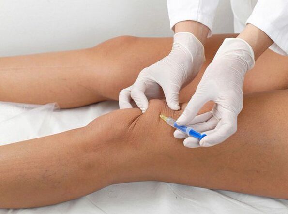 injecție intraarticulară pentru artroza genunchiului
