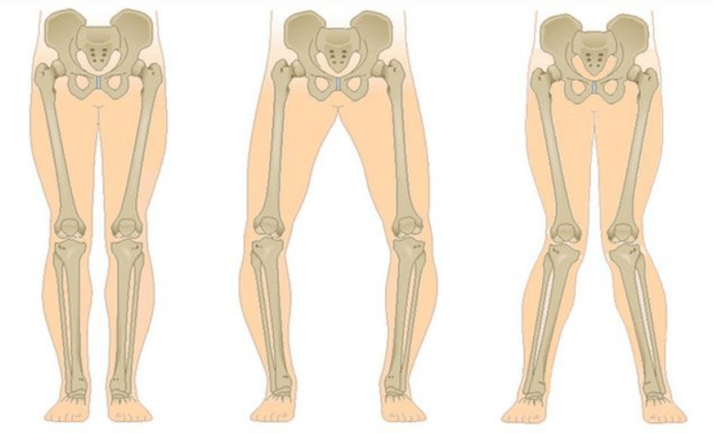 complicații ale artrozei genunchiului
