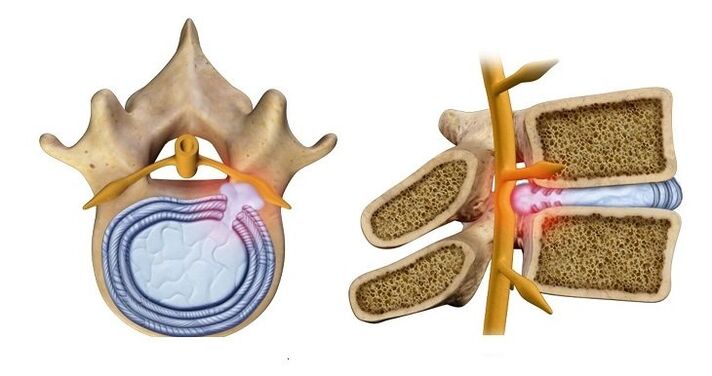 Hernie de disc intervertebrală – proeminența nucleului discului în canalul spinal